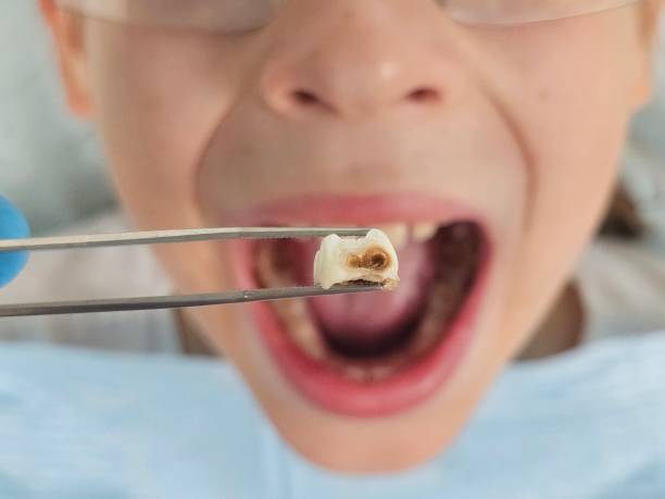 Best Dentist for Tooth Abscess  in Chesapeake Beach, MD